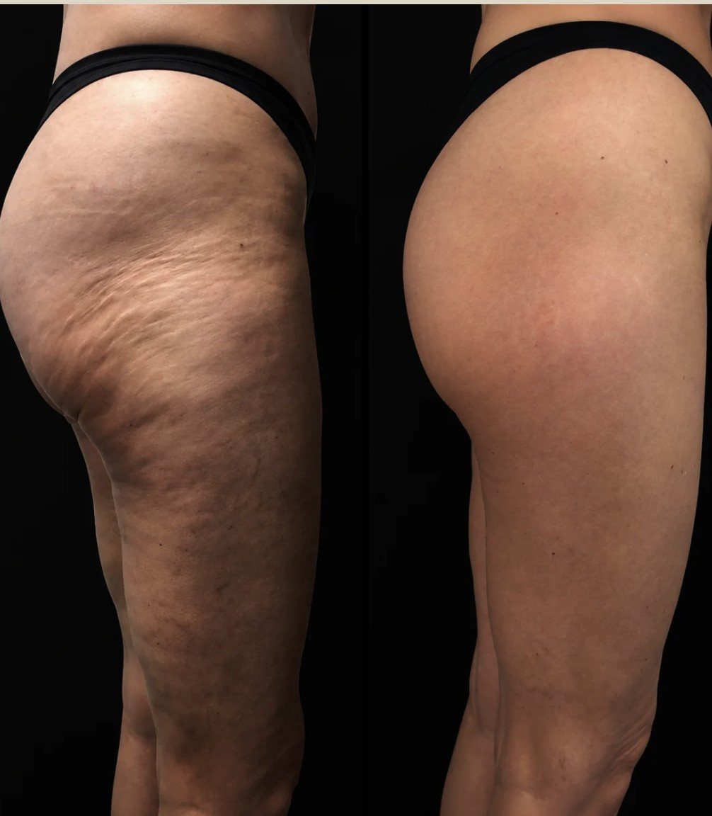 Antes e depois de harmonização glútea com a técnica Glúteo 3D